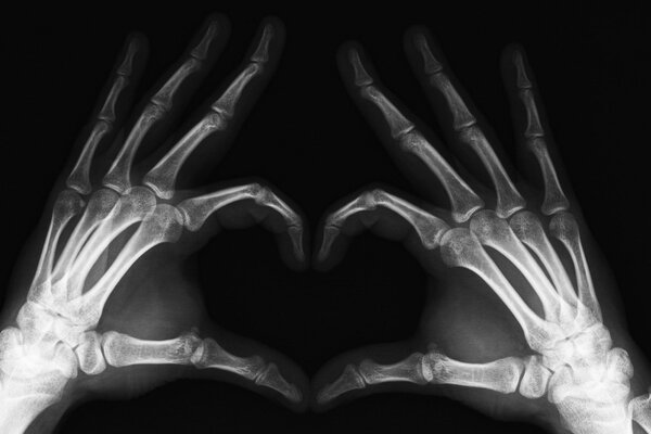 X-ray of hands fingers and limbs